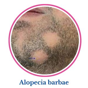 Alopecia barbare